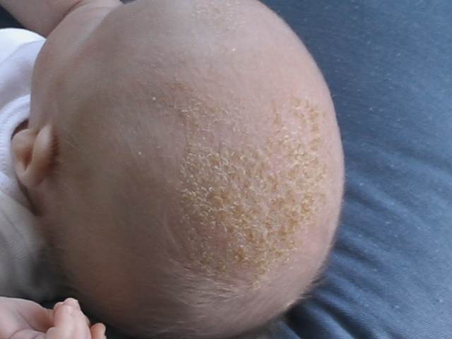 Baby with cradle cap