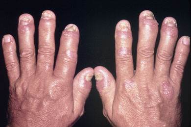 From Louisville Jefferson County Reveals Fingernail Psoriasis Symptoms