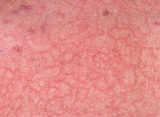 eczemacraquele1.jpg (65007 bytes)