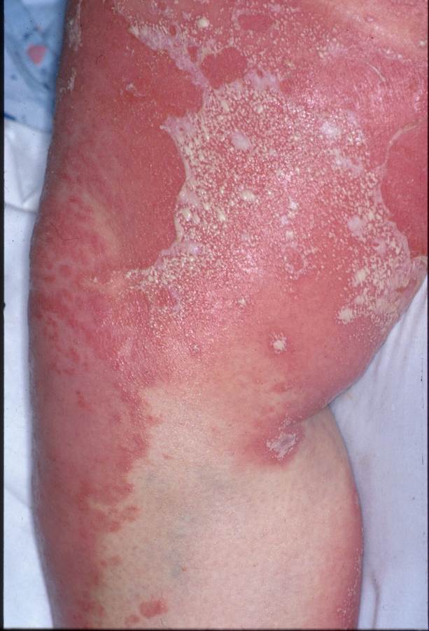 pustular psoriasis