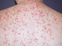 Guttate Psoriasis