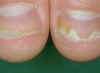 nail psoriasis