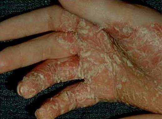 palmoplantar psoriasis