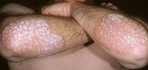 Plaque psoriasis