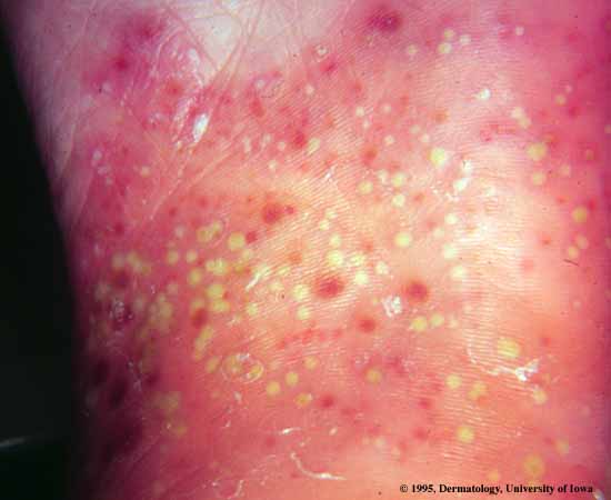 pustular psoriasis