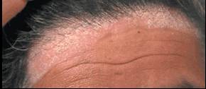 scalp psoriasis