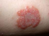 Discoid Eczema