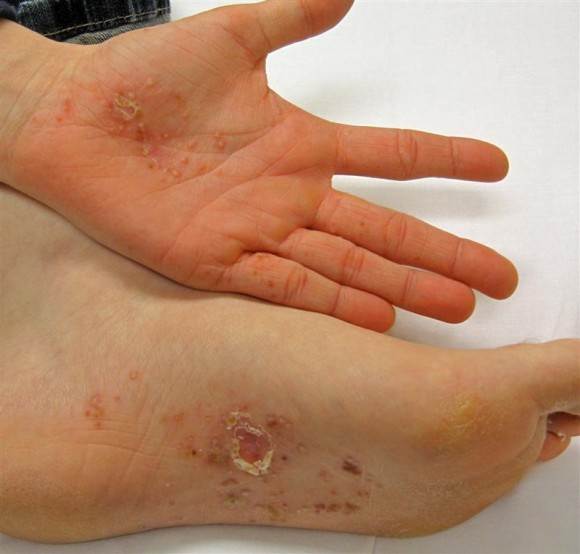 DYSHIDROTIC ECZEMA