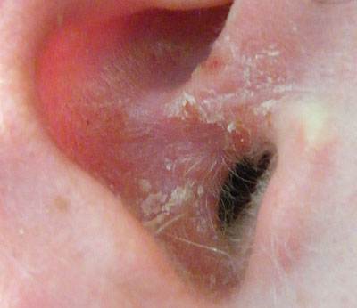 Ear Psoriasis