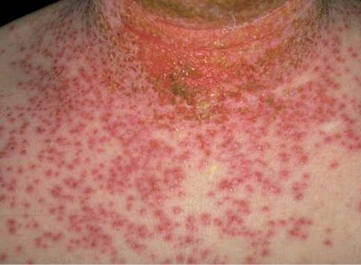 eczema herpeticatum