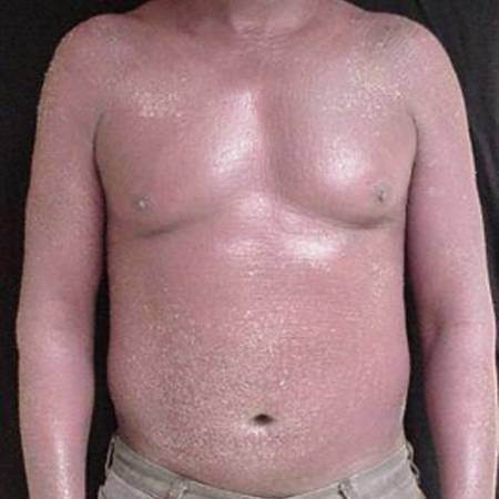 erythrodermic psoriasis