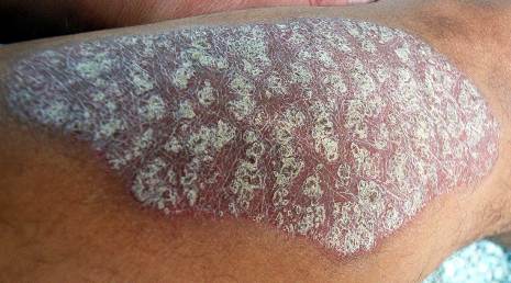 white-scaly patch of psoriasis