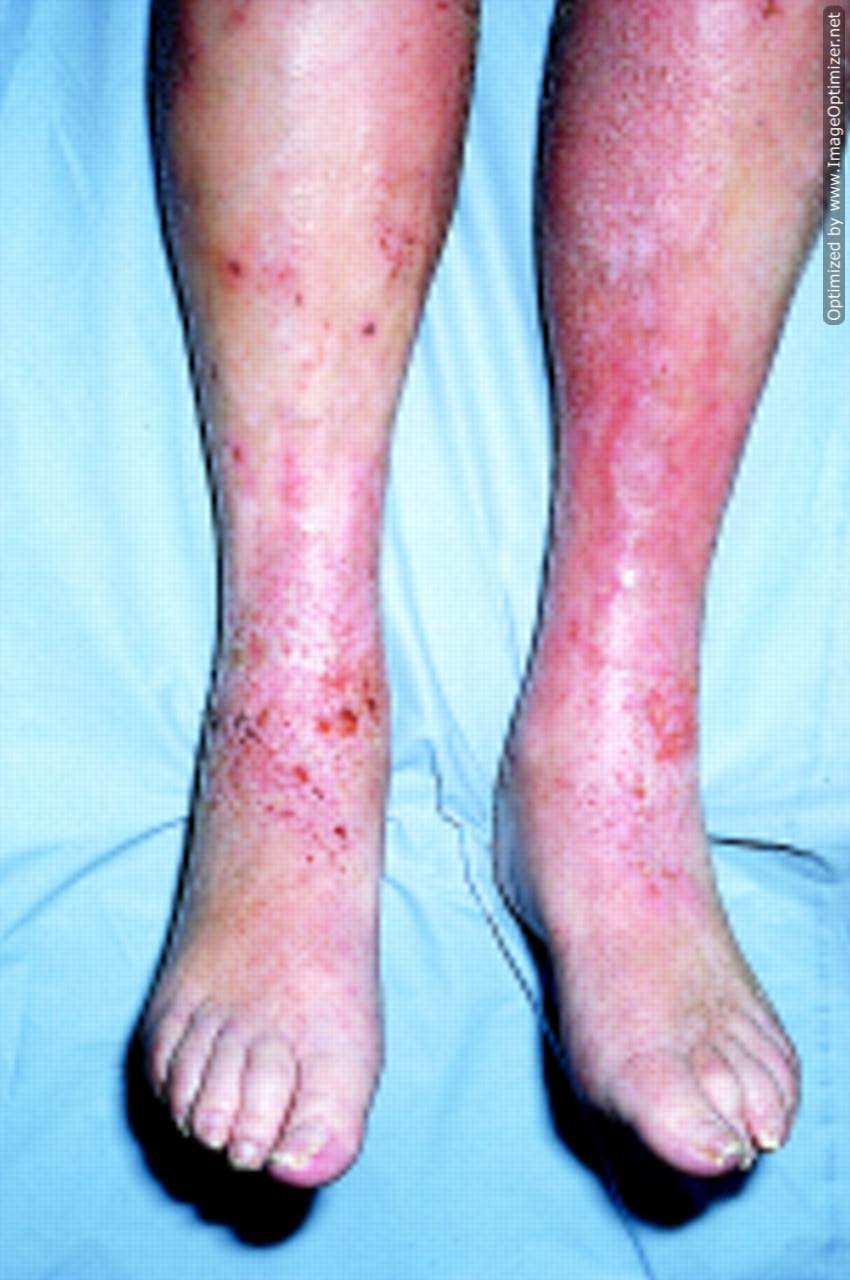 Varicose eczema